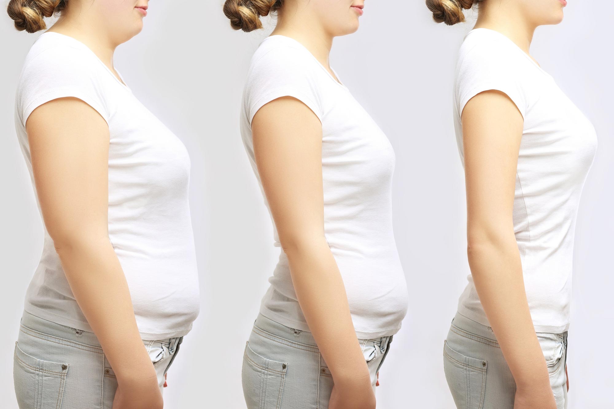 Obesity Weight Loss Concept 1