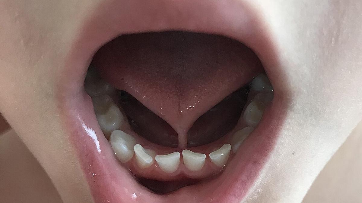 Ankyloglossia 1