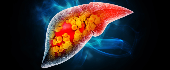 Fat Mass With Liver Disease