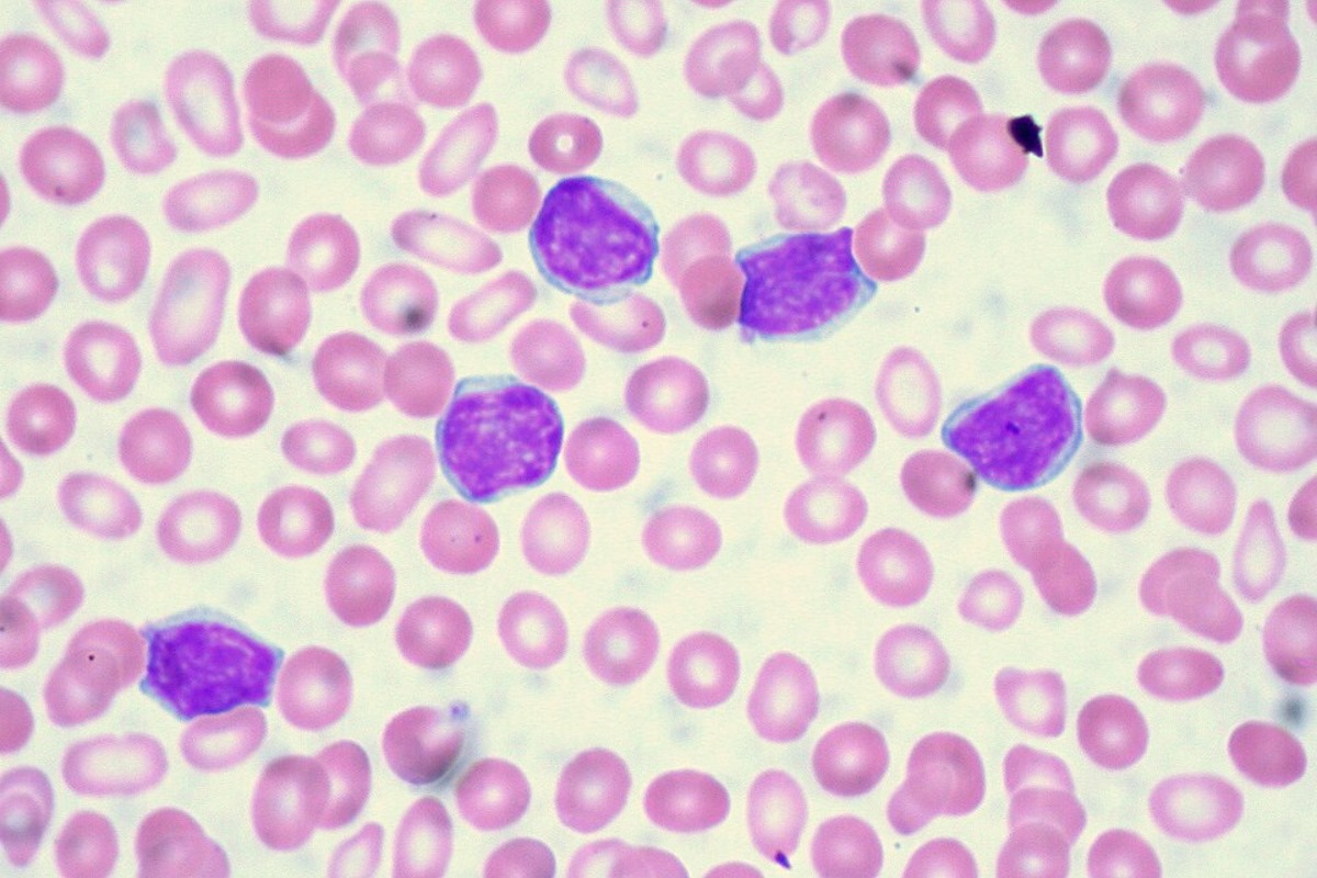 cincinnati breakthrough novel drug bexobrutideg stuns with success in cll battle is fda approval next 2