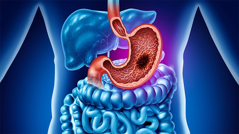 dt 250605 stomach cancer 800x450 1