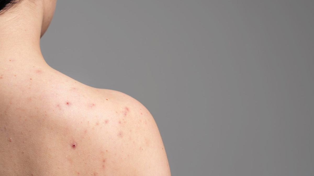 mn body acne 1751023092204