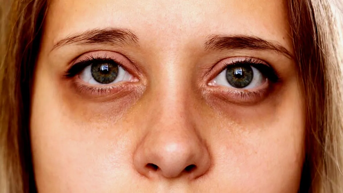 Main puffy eyes 1752830454787