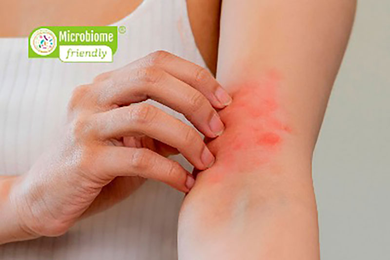 global first microbiome friendly standard for eczema prone