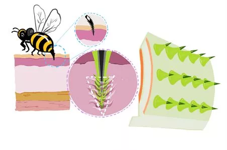 Novel Microneedle patches
