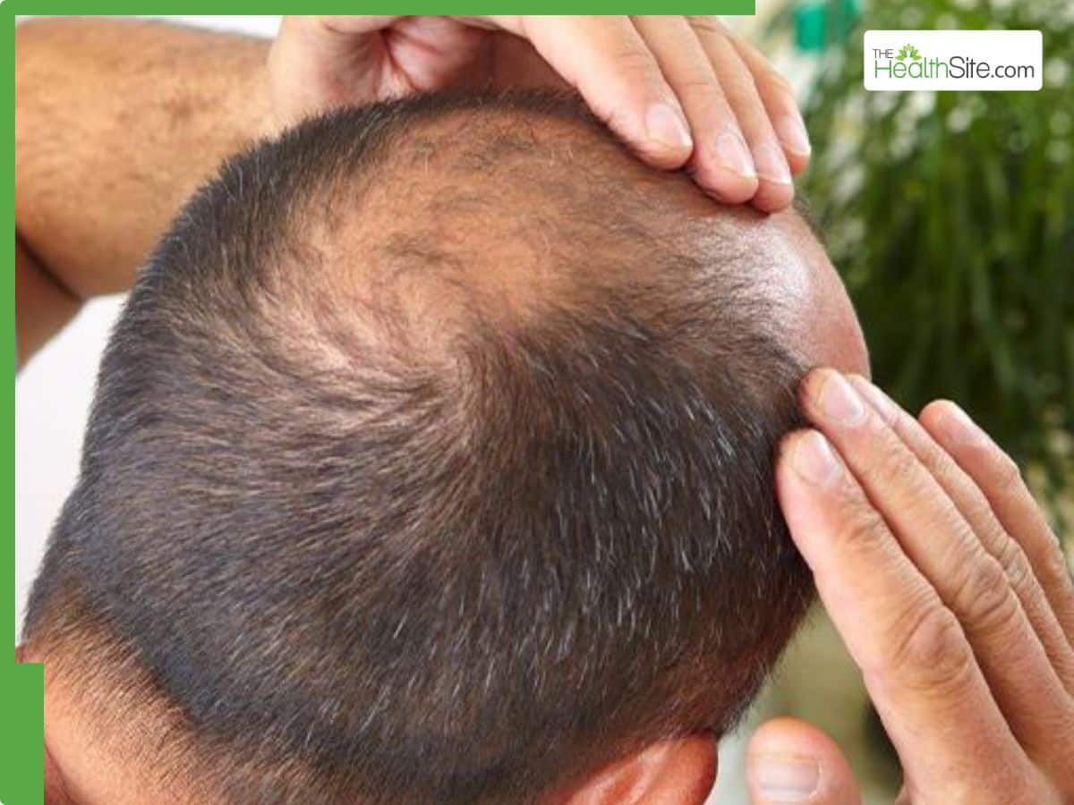Baldness in Men 7 Proven Ways to Regrow Hair Fast at Home