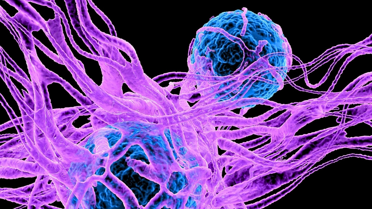 Serotonin Could Play an Unexpected Role in Cancer, Scientists Discover 5 Cancer Cells in Blue and Purple Bright