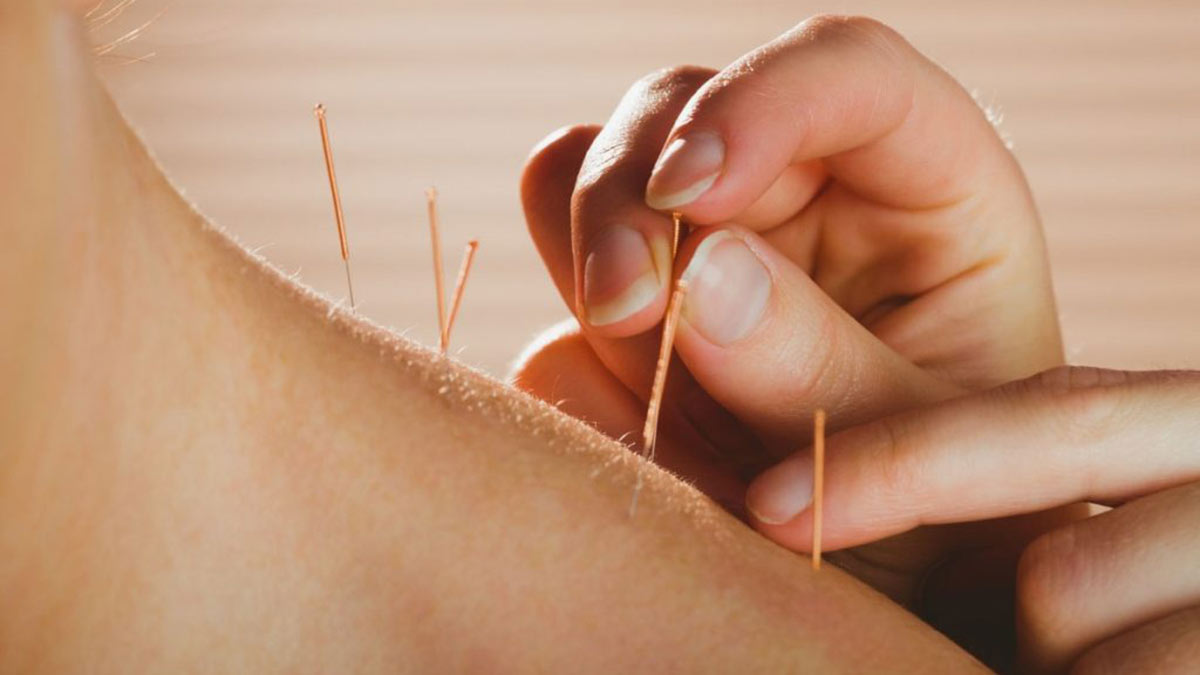 39 An accupuncture session at National Institute of Naturopathy in Pune