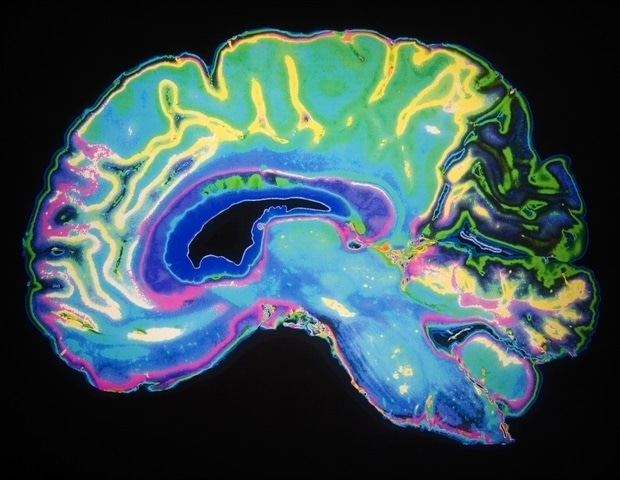 Artificially Colored MRI Scan Of Human Brain Daisy Daisy a8c5d8bbbf824bc8932308e30187510f 620x480 1