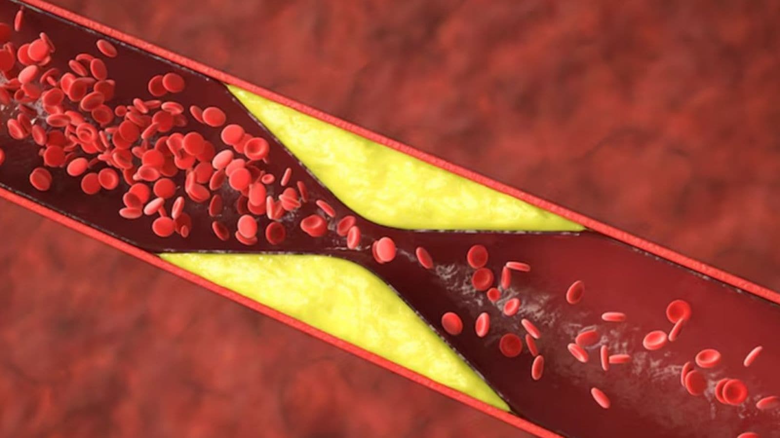 US resets cholesterol guidelines, now test at 19, cut LDL early: Top cardio on why this applies to Indians too 1 chol