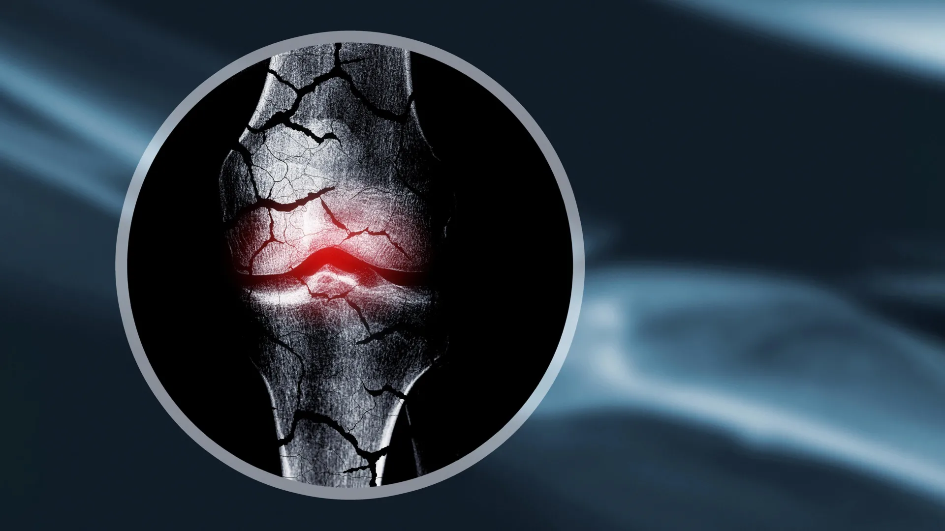 Scientists create cartilage scaffold that helps the body regrow bone 1 x ray cracked broken bones