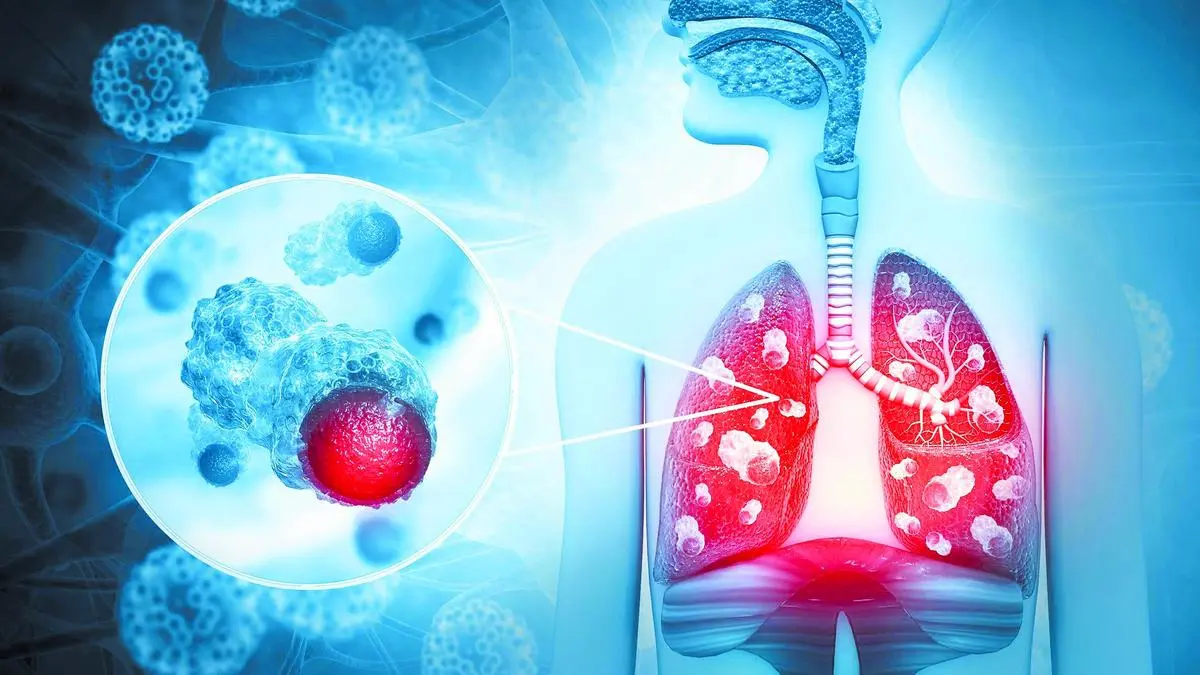 Telangana govt declares cancer as a notifiable disease 1 IMG BL0901 Quantum Tube1 2 1 K3ANMIDR