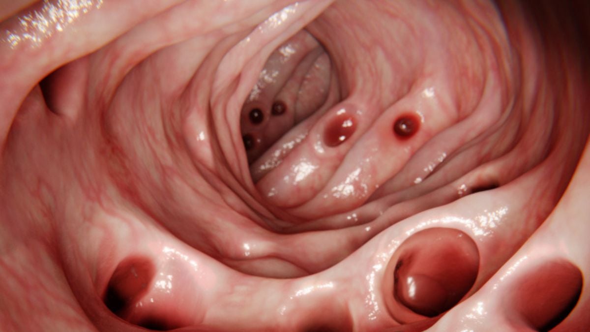 Diverticulosis
