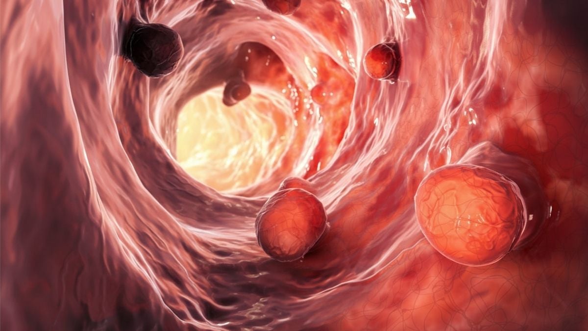 Gut Microbiome Could Remain Disrupted For Over a Decade After Polyp Removal - ScienceAlert 2 PolypRemoval 1