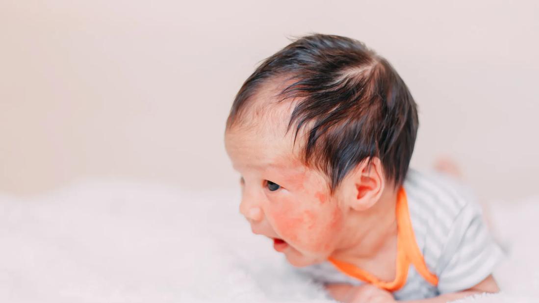 peds eczema